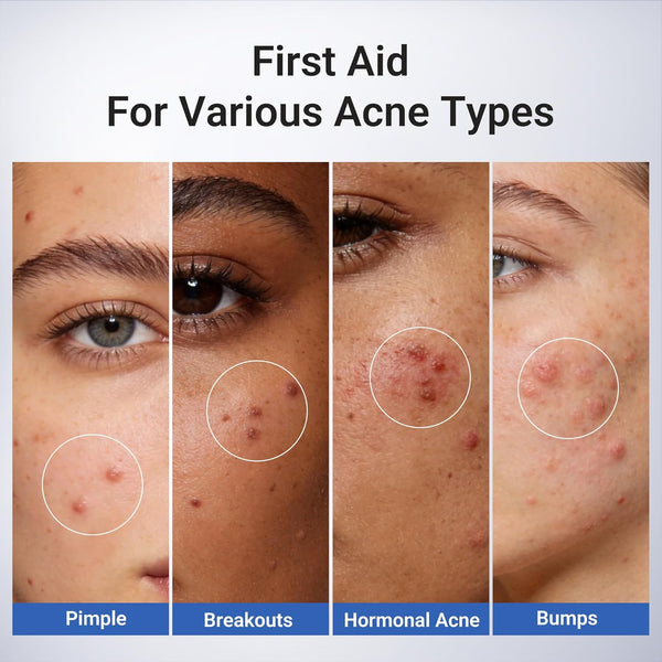 ClearFast Salicylic Spot Serum within 7 days